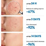 Salicylic Acid Acne Removal Cream Anti-Acne Repair Redness Pimple Spots Deep Cleaning Pore Oil Control Moisturizing - Image 4