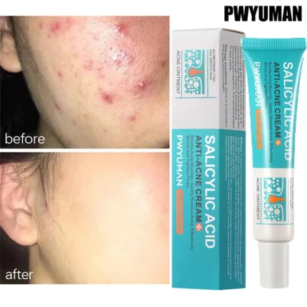 Salicylic Acid Acne Removal Cream Anti-Acne Repair Redness Pimple Spots Deep Cleaning Pore Oil Control Moisturizing