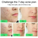 Salicylic Acid Acne Removal Cream Anti-Acne Repair Redness Pimple Spots Deep Cleaning Pore Oil Control Moisturizing - Image 2