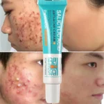 Salicylic Acid Acne Removal Cream Anti-Acne Repair Redness Pimple Spots Deep Cleaning Pore Oil Control Moisturizing - Image 3